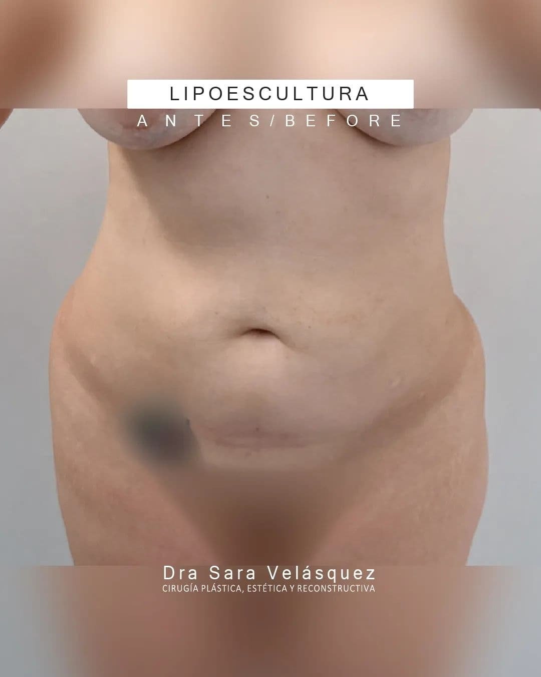 Lipoescultura Antes